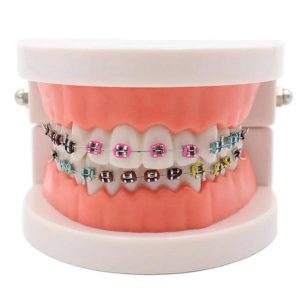 Modeling Clay | Dental Orthodontic Treatment Model With Ortho Metal Ceramic Bracket Arch Wire Buccal Tube Ligature Ties Dentist Tools Lab Learning & Education Modeling Clay